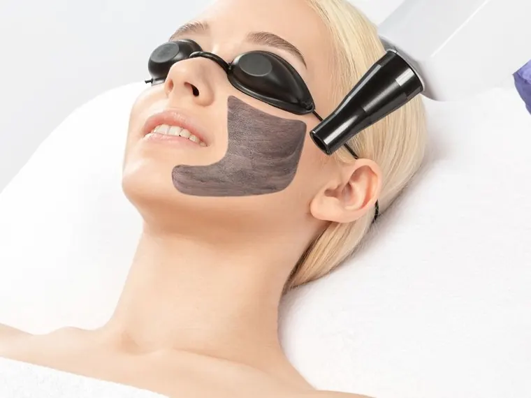 Карбоновый лазерный пилинг — Лазерные процедуры в Neva Beauty, Дананг